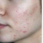 acne treatment acne, acne scars treatment Milton Keynes clinic