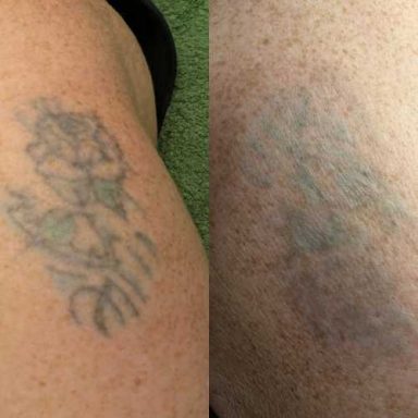 Tattoo Removal Milton Keynes