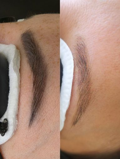Permanent Makeup Removal Results – Art Laser Clinic
