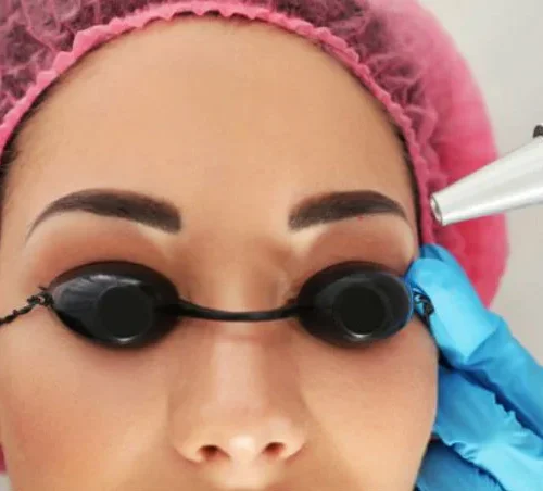 Permanent makeup eyebrow removal with Nd:YAG laser at Art Laser Clinic Milton Keynes