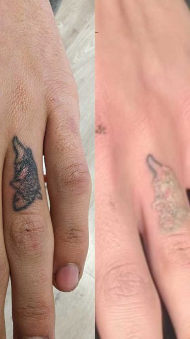 Tattoo Removal Milton Keynes