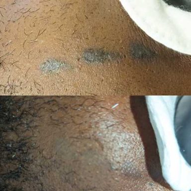 Tattoo Removal Milton Keynes