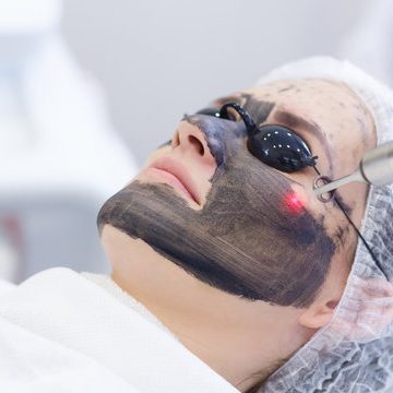 face rejuvination Carbon laser peel (Hollywood facial) procedure brightening skin Art Laser Clinic Milton Keynes